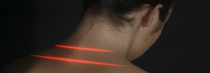 Patient with red cold laser lines on the back of their neck.